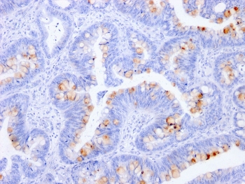 IHC staining of FFPE human colon with CEA antibody (clone C66/1291). HIER: boil tissue sections in pH 9 10mM Tris with 1mM EDTA for 10-20 min and allow to cool before testing.
