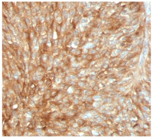 IHC testing of FFPE human bladder carcinoma stained with recombinant Beta-2-Microglobulin antibody (MGBP2-2R). Required HEIR: boil tissue sections in pH 9 10mM Tris with 1mM EDTA for 10-20 min followed by cooling at RT for 20 min.