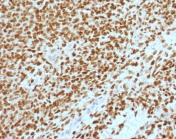 IHC testing of FFPE Ewings sarcoma with NKX2.2 antibody (clone RMNK2-2). HIER: steam sections in pH 9 10mM Tris with 1mM EDTA for 10-20 min.