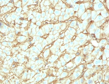IHC testing of FFPE human hepatocellular carcinoma with Albumin antibody (clone ABMN-1). Required HIER: boil tissue sections in 10mM citrate buffer, pH6, for 10-20 min followed by cooling at RT for 20 min.
