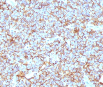 IHC testing of FFPE human Ewing's sarcoma with recombinant CD99 antibody (clone CDLA99-2R). Required HIER: steam sections in 10mM Citrate buffer, pH 6.0, for 10-20 min.