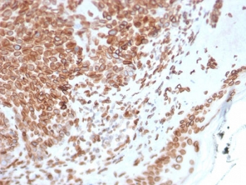 IHC testing of FFPE human basal cell carcinoma with Emerin antibody (clone EMD/2168). Required HIER: boiling tissue sections in 10mM citrate buffer, pH 6, for 10-20 min and allow to cool prior to staining.