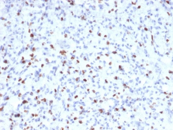 IHC staining of FFPE human rhabdomyosarcoma with Myogenin antibody (clone MYOG/2660). HIER: boil tissue sections in pH6, 10mM citrate buffer, for 10-20 min followed by cooling at RT for 20 min.