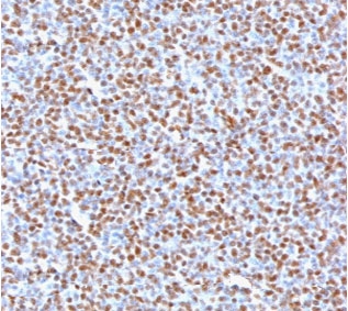 IHC testing of FFPE anaplastic large-cell lymphoma with recombinant ALK antibody (clone ATKR-2R). HIER: boil tissue sections in 10mM Tris buffer with 1mM EDTA, pH 9, for 10-20 min followed by cooling at RT for 20 min.