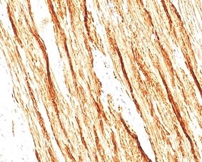 IHC staining of FFPE human colon tissue with recombinant Smoothelin antibody (clone SMTN/2320R). HIER: boil tissue sections in pH6, 10mM citrate buffer, for 20 min and allow to cool before testing.