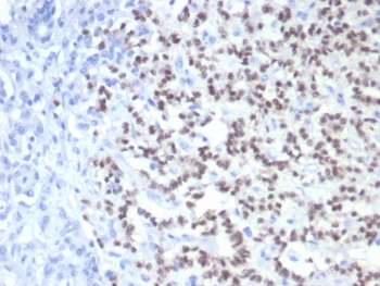 IHC staining of FFPE human pancreatic cancer with PAX6 antibody (clone PAX6/7710). HIER: boil tissue sections in pH 9 10mM Tris with 1mM EDTA for 20 min and allow to cool before testing.