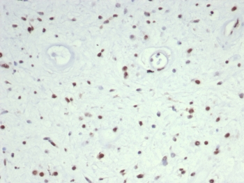 IHC staining of FFPE human rhabdomyosarcoma tissue with MyoD1 antibody (clone MYOD1/7149). HIER: boil tissue sections in pH 9 10mM Tris with 1mM EDTA for 20 min and allow to cool before testing.