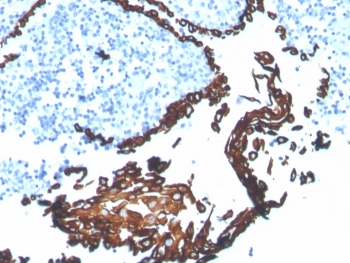 IHC staining of FFPE human tonsil tissue with CK5 antibody (clone KRT5/7500R). HIER: boil tissue sections in pH 9 10mM Tris with 1mM EDTA for 20 min and allow to cool before testing.