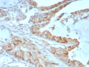 IHC staining of FFPE human colon cancer tissue with ANXA2 antibody (clone 3D5/4). HIER: boil tissue sections in pH 9 10mM Tris with 1mM EDTA for 20 min and allow to cool before testing.