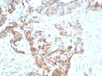 IHC staining of FFPE human gastric carcinoma with TNFRSF17 antibody (clone BCMA/7253). HIER: boil tissue sections in pH 9 10mM Tris with 1mM EDTA for 20 min and allow to cool before testing.
