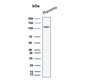 IHC staining of FFPE human prostate carcinoma tissue with recombinant CDH1 antibody (clone rCDH1/7352). Inset: PBS used in place of primary Ab (secondary Ab negative control). HIER: boil tissue sections in pH 9 10mM Tris with 1mM EDTA for 20 min and allow to cool before testing.