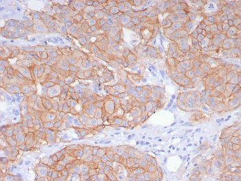 IHC staining of FFPE human breast carcinoma tissue with recombinant HER2 antibody (clone ERBB2/8142R). HIER: boil tissue sections in pH 9 10mM Tris with 1mM EDTA for 20 min and allow to cool before testing.