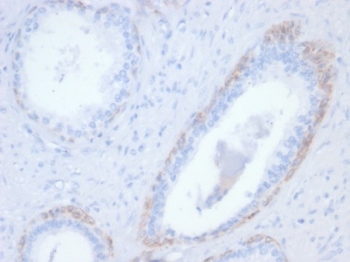 IHC staining of FFPE human prostate tissue with recombinant KRT14 antibody (clone rKRT14/7368). HIER: boil tissue sections in pH 9 10mM Tris with 1mM EDTA for 20 min and allow to cool before testing.