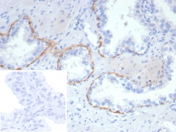 IHC staining of FFPE human prostate tissue with CK14 antibody (clone rKRT14/7269). Inset: PBS used in place of primary Ab (secondary Ab negative control). HIER: boil tissue sections in pH 9 10mM Tris with 1mM EDTA for 20 min and allow to cool before testing.