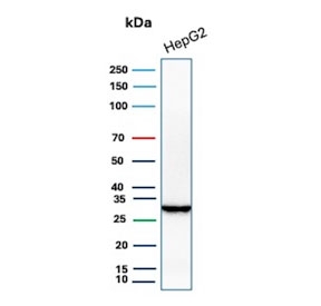 IHC staining of FFPE human hepatocellular carcinoma tissue with Succinate dehydrogenase B antibody (clone SDHB/8974R). HIER: boil tissue sections in pH 9 10mM Tris with 1mM EDTA for 20 min and allow to cool before testing.