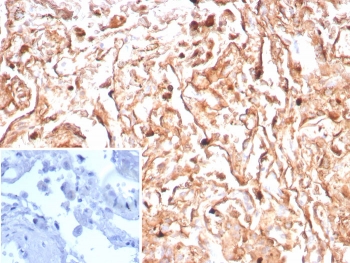 IHC staining of FFPE human tonsil tissue with Podoplanin antibody (clone PDPN/8950R). Inset: PBS used in place of primary Ab (secondary Ab negative control). HIER: boil tissue sections in pH 9 10mM Tris with 1mM EDTA for 20 min and allow to cool before testing.