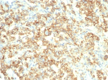 IHC staining of FFPE human bladder tissue with S100A14 antibody (clone S100A14/7403). HIER: boil tissue sections in pH 9 10mM Tris with 1mM EDTA for 20 min and allow to cool before testing.