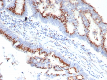 IHC staining of FFPE human colon carcinoma tissue with OVOL2 antibody (clone OVOL2/6776). HIER: boil tissue sections in pH 9 10mM Tris with 1mM EDTA for 20 min and allow to cool before testing.