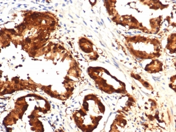 IHC staining of FFPE human prostate tissue with IDH1-R132H mutation with IDH1-R132H Mutant antibody (clone IDH1.R132H/8205R). HIER: boil tissue sections in pH 9 10mM Tris with 1mM EDTA for 20 min and allow to cool before testing.