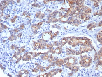 IHC staining of FFPE human colon adenocarcinoma with VIL1 antibody (clone rVIL1/8336). HIER: boil tissue sections in pH 9 10mM Tris with 1mM EDTA for 20 min and allow to cool before testing.