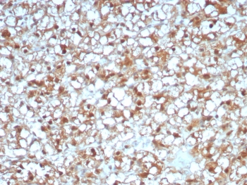 IHC staining of FFPE human renal cell carcinoma tissue with ADH1L1 antibody (clone ALDH1L1/7969). HIER: boil tissue sections in pH 9 10mM Tris with 1mM EDTA for 20 min and allow to cool before testing.