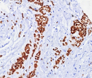 Formalin fixed paraffin embedded human breast carcinoma tissue with ER alpha antibody (clone ESR1/7444R). HIER: boil tissue sections in pH 9 10mM Tris with 1mM EDTA for 20 min and allow to cool before testing.