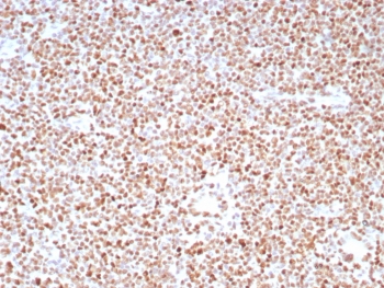 IHC staining of FFPE human colon carcinoma tissue with PMS2 antibody (clone PMS2/8224R). HIER: boil tissue sections in pH 9 10mM Tris with 1mM EDTA for 20 min and allow to cool before testing.