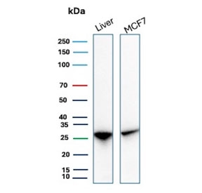 IHC staining of FFPE human renal cell carcinoma tissue with HSP27 antibody (clone rHSPB1/7298). HIER: boil tissue sections in pH 9 10mM Tris with 1mM EDTA for 20 min and allow to cool before testing.