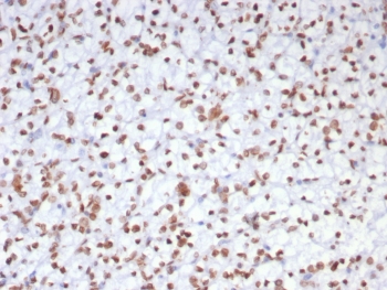 IHC staining of FFPE human renal cell carcinoma tissue with EZH2 antibody (clone EZH2/7507). HIER: boil tissue sections in pH 9 10mM Tris with 1mM EDTA for 20 min and allow to cool before testing.