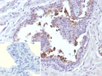 IHC staining of FFPE human prostate cancer tissue with ABCC4 antibody (clone ABCC4/9018). Inset: PBS used in place of primary Ab (secondary Ab negative control).