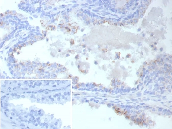 IHC staining of FFPE human prostate cancer tissue with ABCC4 antibody (clone ABCC4/9019). Inset: PBS used in place of primary Ab (secondary Ab negative control).
