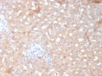 IHC staining of FFPE human hepatocellular carcinoma tissue with ADH1L1 antibody (clone ALDH1L1/7970). HIER: boil tissue sections in pH 9 10mM Tris with 1mM EDTA for 20 min and allow to cool before testing.