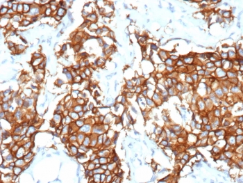IHC staining of FFPE human breast cancer tissue with recombinant ErbB2 antibody (clone rERBB2/9538). HIER: boil tissue sections in pH 9 10mM Tris with 1mM EDTA for 20 min and allow to cool before testing.