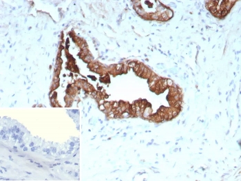 IHC staining of FFPE human prostate cancer tissue with recombinant KRT19 antibody (clone rKRT19/9108). Inset: PBS used in place of primary Ab (secondary Ab negative control). HIER: boil tissue sections in pH 9 10mM Tris with 1mM EDTA for 20 min and allow to cool before testing.