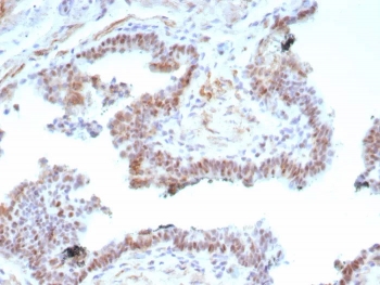 IHC staining of FFPE human prostate carcinoma tissue with recombinant Androgen Receptor V7 antibody (clone DHTR.V7/9125R). HIER: boil tissue sections in pH 9 10mM Tris with 1mM EDTA for 20 min and allow to cool before testing.