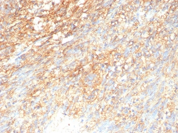 IHC staining of FFPE human GIST tissue with recombinant CD117 antibody (clone rC117/9253. HIER: boil tissue sections in pH 9 10mM Tris with 1mM EDTA for 20 min and allow to cool before testing.