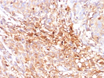 IHC staining of FFPE human triple negative breast cancer tissue with Cyclin B1 antibody (clone CCNB1/7030R). HIER: boil tissue sections in pH 9 10mM Tris with 1mM EDTA for 20 min and allow to cool before testing.