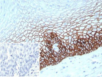 IHC staining of FFPE human esophagus tissue with recombinant CD44v6 antibody (clone CD44V6/9400R). Inset: PBS used in place of primary Ab (secondary Ab negative control). HIER: boil tissue sections in pH 9 10mM Tris with 1mM EDTA for 20 min and allow to cool before testing.