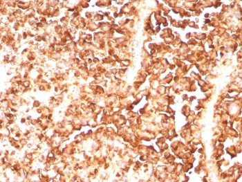IHC staining of FFPE human melanoma tissue with recombinant S100A1 antibody (clone S100A1/9244R). HIER: boil tissue sections in pH 9 10mM Tris with 1mM EDTA for 20 min and allow to cool before testing.
