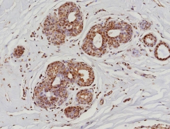 IHC staining of FFPE human breast cancer tissue with recombinant Phospho-RNA Polymerase II CTD Repeat YSPTSPS antibody (clone POLR2A/9089R). HIER: boil tissue sections in pH 9 10mM Tris with 1mM EDTA for 20 min and allow to cool before testing.