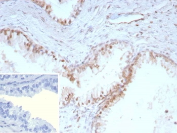 IHC staining of FFPE human prostate tissue. Strong nuclear staining observed using recombinant p27 antibody at 2ug/ml. HIER: boil tissue sections in pH 9 10mM Tris with 1mM EDTA for 20 min and allow to cool before testing.