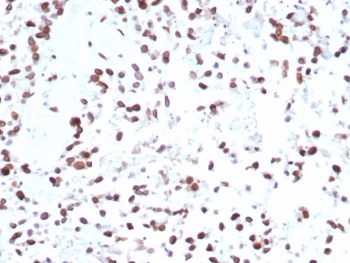 IHC staining of FFPE human bladder tissue with MDM2 antibody (clone MDM2/7943). HIER: boil tissue sections in pH 9 10mM Tris with 1mM EDTA for 20 min and allow to cool before testing.