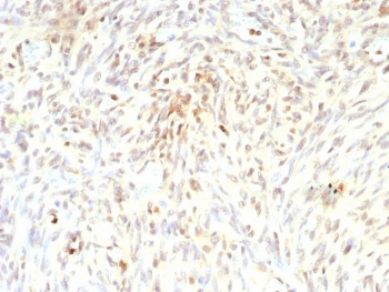 IHC staining of FFPE human liposarcoma tissue with recombinant MDM2 antibody (clone rMDM2/9214). HIER: boil tissue sections in pH 9 10mM Tris with 1mM EDTA for 20 min and allow to cool before testing.