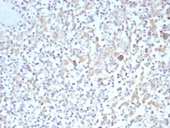 IHC staining of FFPE human Hodgkins lymphoma tissue with recombinant Bcl-X antibody (clone BCL2L1/9221R). HIER: boil tissue sections in pH 9 10mM Tris with 1mM EDTA for 20 min and allow to cool before testing.