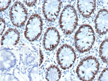 IHC staining of FFPE human colon tissue with recombinant GTBP antibody (clone MSH6/13194R). Inset: PBS used in place of primary Ab (secondary Ab negative control). HIER: boil tissue sections in pH 9 10mM Tris with 1mM EDTA for 20 min and allow to cool before testing.