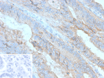Immunohistochemistry analysis of Cadherin 3 (P-cadherin) expression. CDH3/Cadherin 3 antibody (clone r56C1) staining was performed on formalin-fixed, paraffin-embedded human colon carcinoma tissue, showing DAB-positive membranous and cytoplasmic staining in tumor epithelial cells, with hematoxylin counterstaining. The inset shows a negative control processed in parallel using PBS in place of the primary antibody, demonstrating minimal background signal with secondary antibody only.