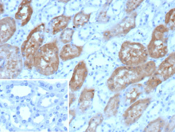 Immunohistochemistry analysis of Cadherin 6 (CDH6) expression. CDH6/Cadherin 6 antibody (clone CDH6/9347) staining was performed on formalin-fixed, paraffin-embedded human renal cell carcinoma tissue, showing DAB-positive membranous and cytoplasmic staining in tumor cells, with hematoxylin counterstaining. The inset shows a negative control processed in parallel using PBS in place of the primary antibody, demonstrating minimal background signal with secondary antibody only.