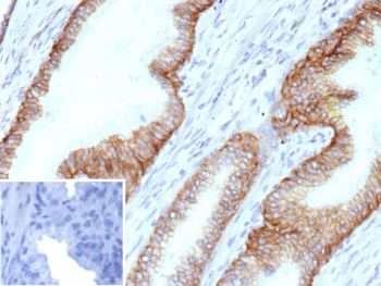 Immunohistochemical analysis of ABCC4 in FFPE human prostate tissue using an ABCC4 antibody (clone ABCC4/9178). Brown membranous and cytoplasmic staining is observed in epithelial cells, consistent with ATP-binding cassette sub-family C member 4 localization. Staining of formalin-fixed tissues requires heating tissue sections in 10 mM Tris with 1 mM EDTA, pH 9.0, for 45 minutes at 95 C followed by cooling at room temperature for 20 minutes. Inset shows a negative control section processed in parallel using PBS in place of the primary antibody, demonstrating minimal background staining.