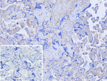 Immunohistochemistry analysis of formalin-fixed, paraffin-embedded human placenta tissue using CHAT antibody (clone r38B12). Weak to moderate cytoplasmic staining is observed in scattered placental cells, with minimal background signal in surrounding stromal regions. Nuclei are counterstained in blue. Inset shows PBS substituted for the primary antibody as a secondary-only negative control. Heat-induced antigen retrieval was performed by heating tissue sections in 10 mM Tris with 1 mM EDTA, pH 9.0, for 45 minutes at 95oC, followed by cooling at room temperature for 20 minutes.