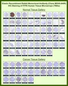 Immunohistochemistry tissue microarray analysis of Elastin expression. Recombinant ELN/Elastin antibody (clone MSVA-648R) was evaluated by immunohistochemistry on formalin-fixed, paraffin-embedded human tissue microarrays representing a broad panel of normal and cancer tissues. Staining highlights extracellular matrix-associated and elastic fiber localization in tissues known to contain elastic structures, including vascular, pulmonary, and connective tissue compartments, with minimal staining in tissues lacking elastic fibers. Cancer tissues show variable stromal and vascular-associated immunoreactivity depending on tumor type. Overall staining distribution and relative expression patterns are consistent with publicly available expression data reported by the Human Protein Atlas, supporting the biological relevance of the observed immunostaining.